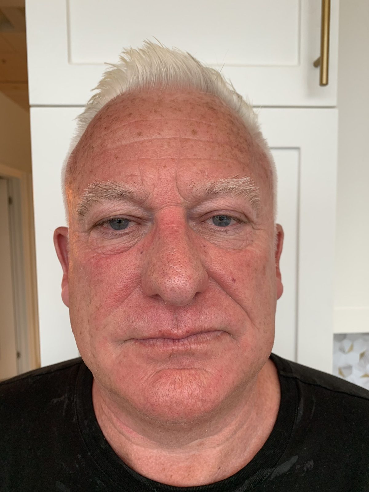morpheus8 before and after